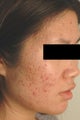 Pulsed Dye Laser Treatment for Red Acne Scars  