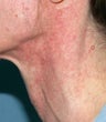 PDL treatment on neck 