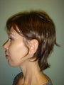 Face Lift, Quick lIft, Mini Face Lift