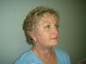 Face Lift, Quick lIft, Mini Face Lift