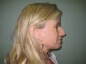 Facelift, Mini Face Lift, Quicklift