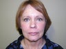 Face Lift, Quick lIft, Mini Face Lift