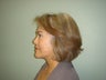 Face Lift, Quick lIft, Mini Face Lift