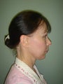 Facelift, Mini Face Lift, Quicklift