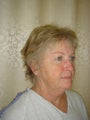 Face Lift, Quick lIft, Mini Face Lift