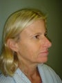 Facelift, Mini Face Lift, Quicklift