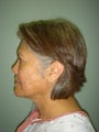 Face Lift, Quick lIft, Mini Face Lift