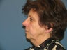 Quicklift w/neck liposuction