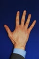 Radiesse Hand Rejuvenation