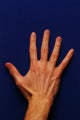 Radiesse Hand Rejuvenation