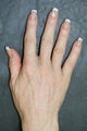 Radiesse treatment for hand rejuvenation