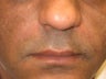 Radiesse Injections 