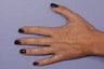 Radiesse to Hands