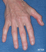 Radiesse Filler Augmentation of the Hands