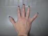 Radiesse- Hands