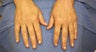 Radiesse Hands 