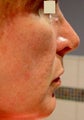 Radiesse Cheek Lift 