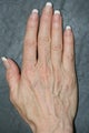 Radiesse treatment for hand rejuvenation