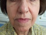 Radiesse to the face/ nasolabial folds