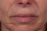 Radiesse to Lower Face