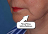 Radiesse Augmentation of the Marionette Line