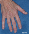 Radiesse Filler Augmentation of the Hands