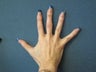Radiesse- Hands