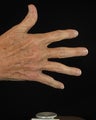 Hand Rejuvenation 
