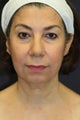 Radiesse with Buccal Fat Removal, Chin Augmentation, upper/lower blepharoplasty, and facelift