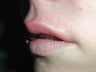 Restylane