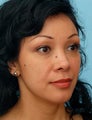 Restylane Treatment to the Eyes and Cheeks