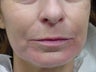 Restylane treatment for marionette lines 