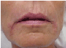 Restylane