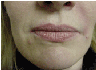 restylane 