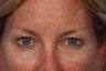 Restylane to Tear Trough (under eyes)