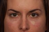 Restylane to Tear Troughs (under eyes)