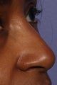 Restylane - Nose
