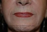 Dermal Filler Injection to Marionette and Accessory Smile Lines