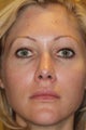 Restylane to Lips