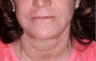 Extreme filler a.k.a liquid facelift