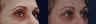 Upper eyelid filler with restylane