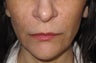Restylane