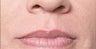Restylane