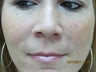 Restylane
