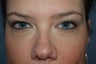 Restylane used in tear trough 