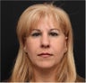 Juvederm