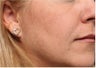 Restylane