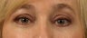 Lower Eyelid/Tear-Trough Restyalne