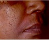 Restylane/Juvederm