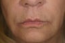 Restylane